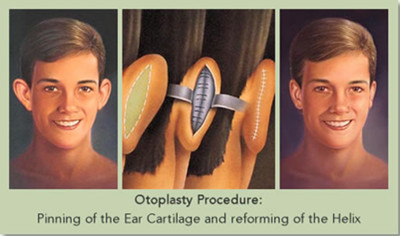 图解招风耳矫正手术过程